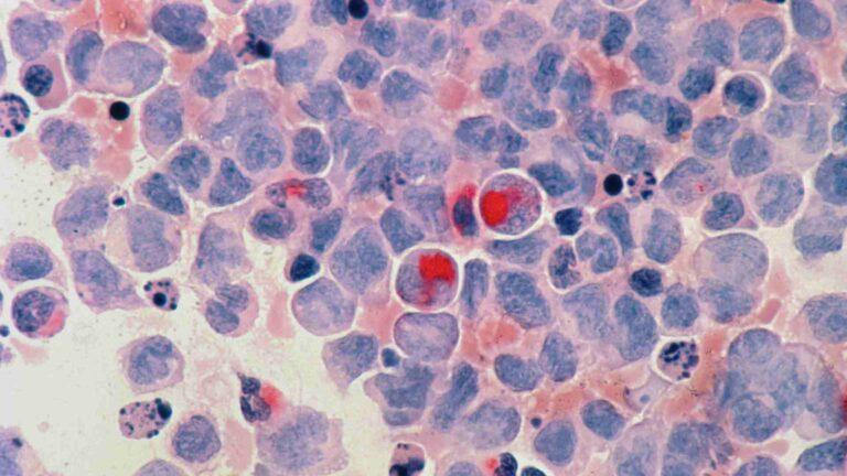 Más de 18 millones de personas en el mundo morirán de cáncer en 2050, un 75% más que ahora