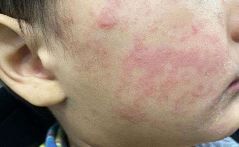 México acumula 24 muertes y casi seis mil casos de sarampión