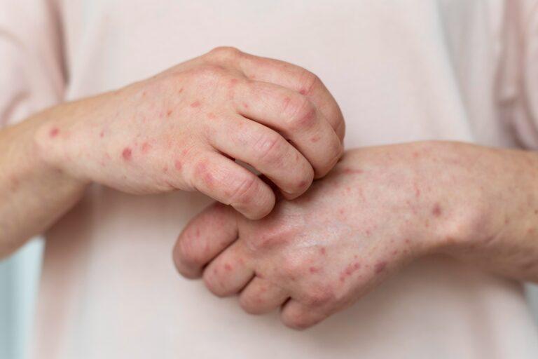 Brote de sarampión en México: Estados con más casos al 11 de febrero de 2026