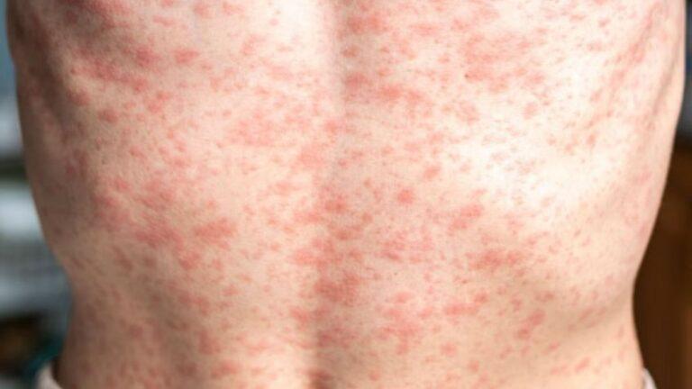 Suman 541 casos de sarampión confirmados en la CDMX por Nadine Gasman, secretaría de Salud capitalina